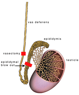 FAQs – Vasectomy Reversal USA